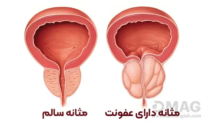 درمان عفونت مثانه در زنان با طب سنتی