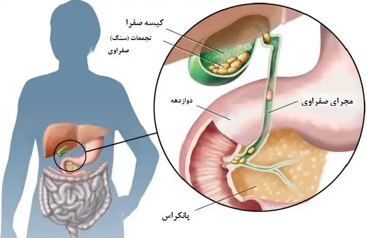 قویترین داروی گیاهی سنگ شکن صفرا