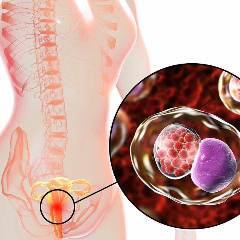 علائم کلامیدیا در زنان