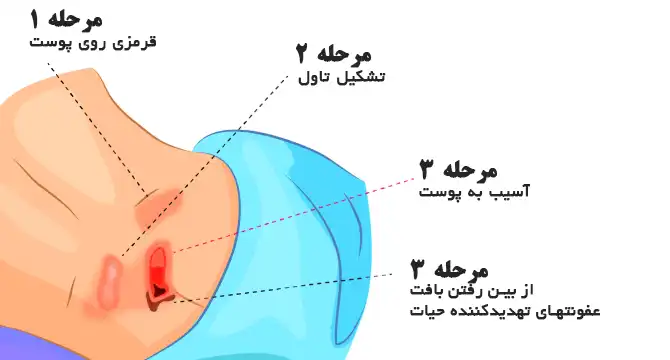 مراحل زخم بستر