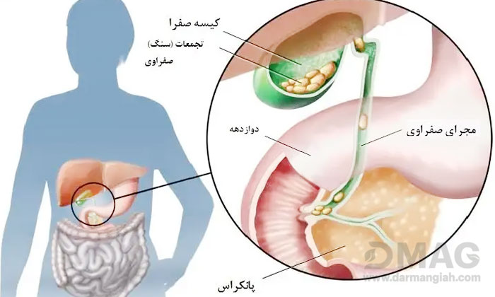 قرص پاکسازی کیسه صفرا