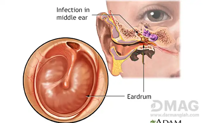 درمان سریع عفونت سوراخ گوش