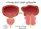 هایپرپلازی خوش خیم پروستات: از دلایل تا درمان