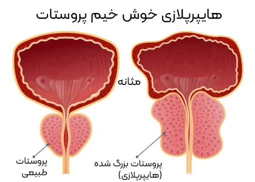 هایپرپلازی خوش خیم پروستات