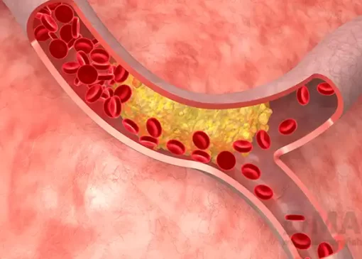 قاتل چربی خون بالا چیست