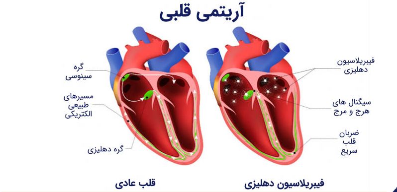 قرص آریتمی قلب